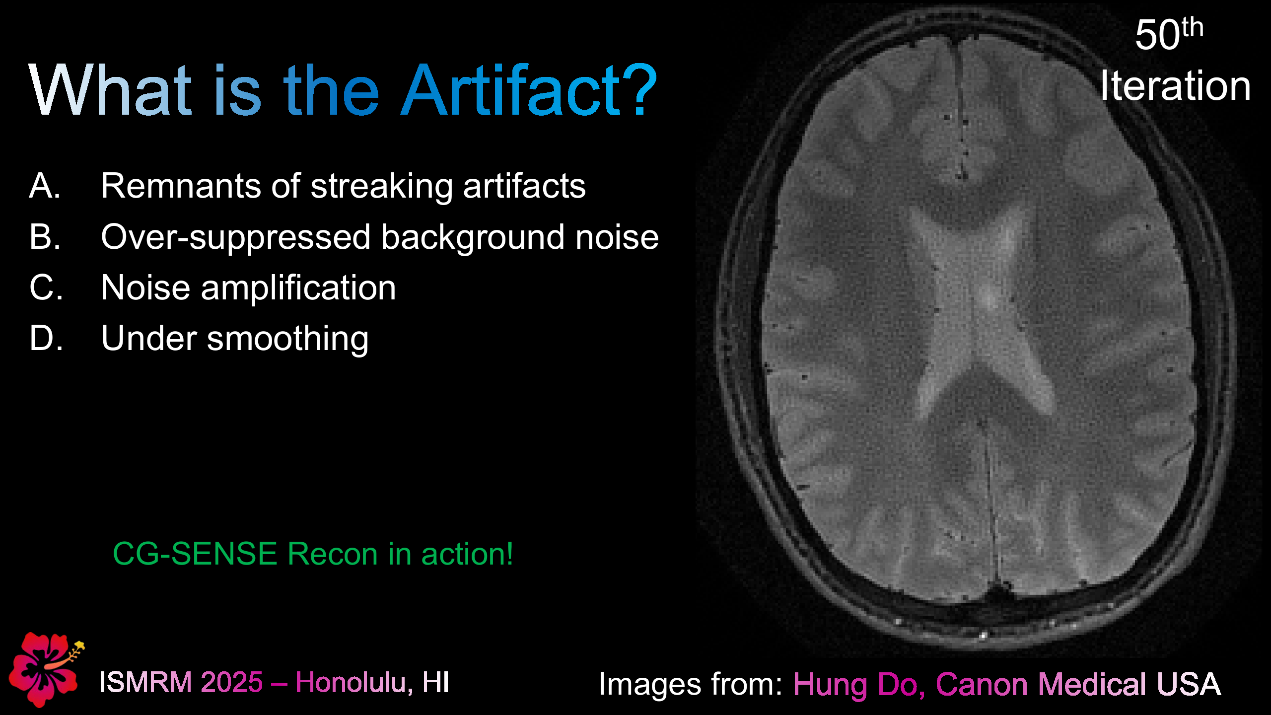 Mysterious Artifact in Radial MRI