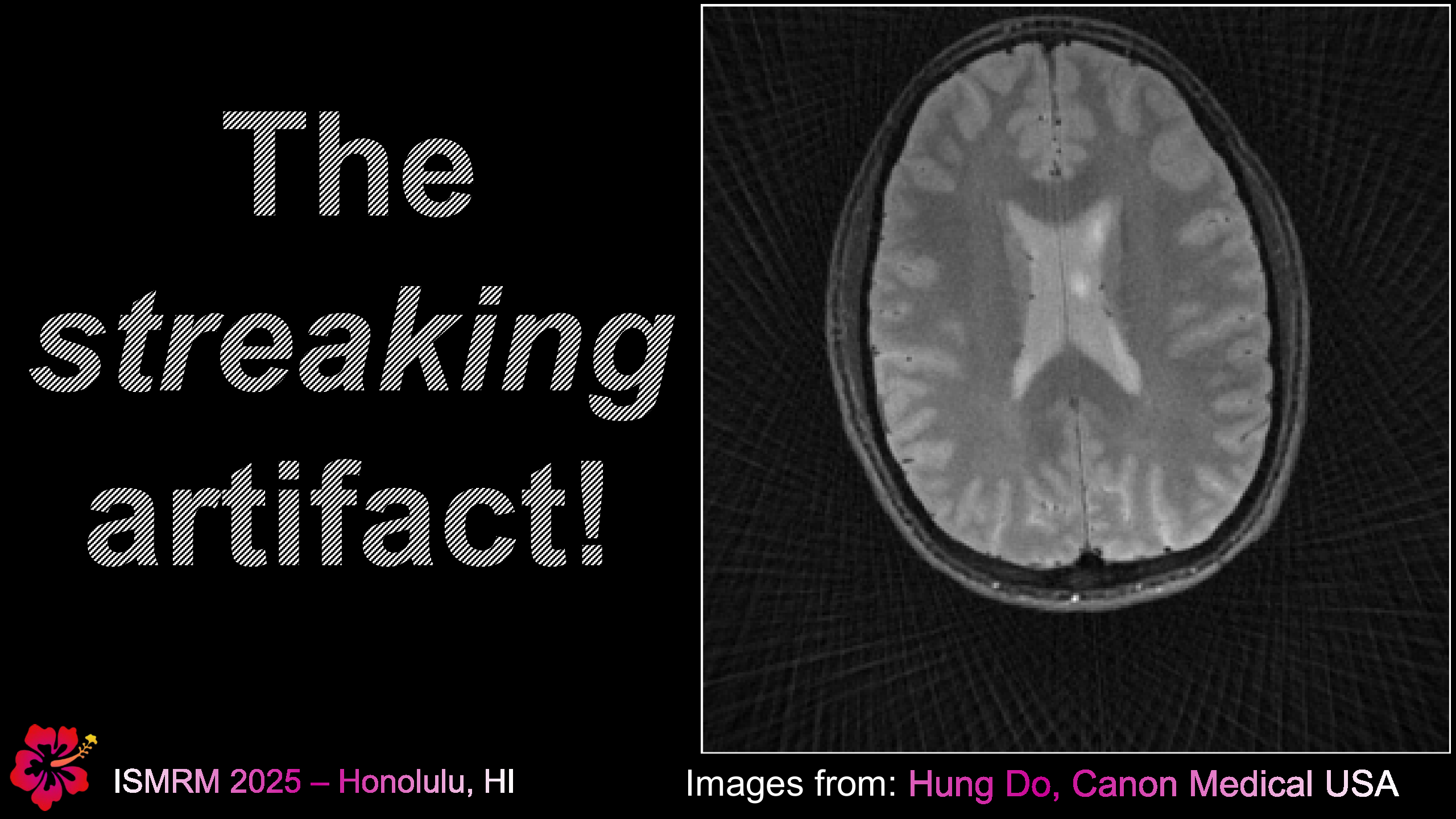 Streaking Artifact in Radial MRI