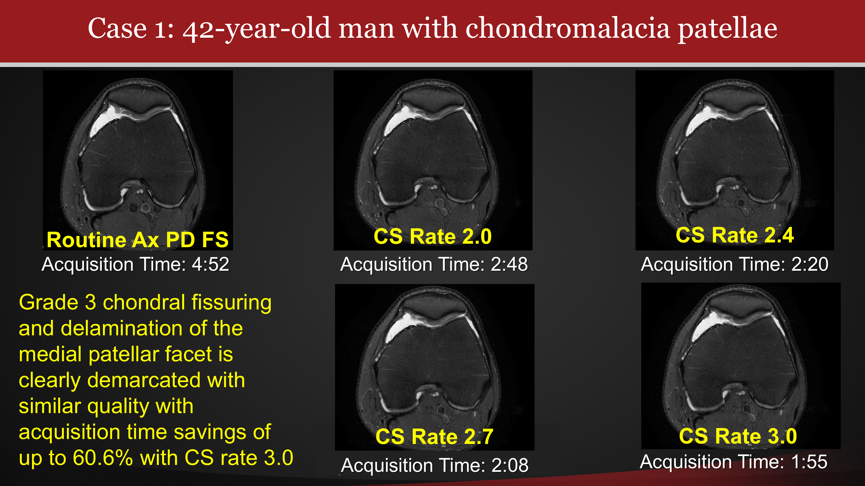 MRI Compressed Sensing Reconstruction