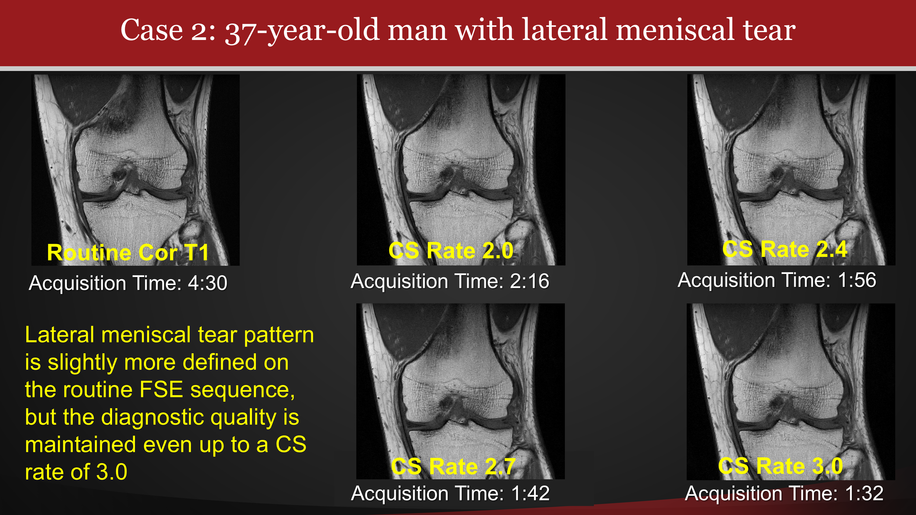 MRI Compressed Sensing Reconstruction