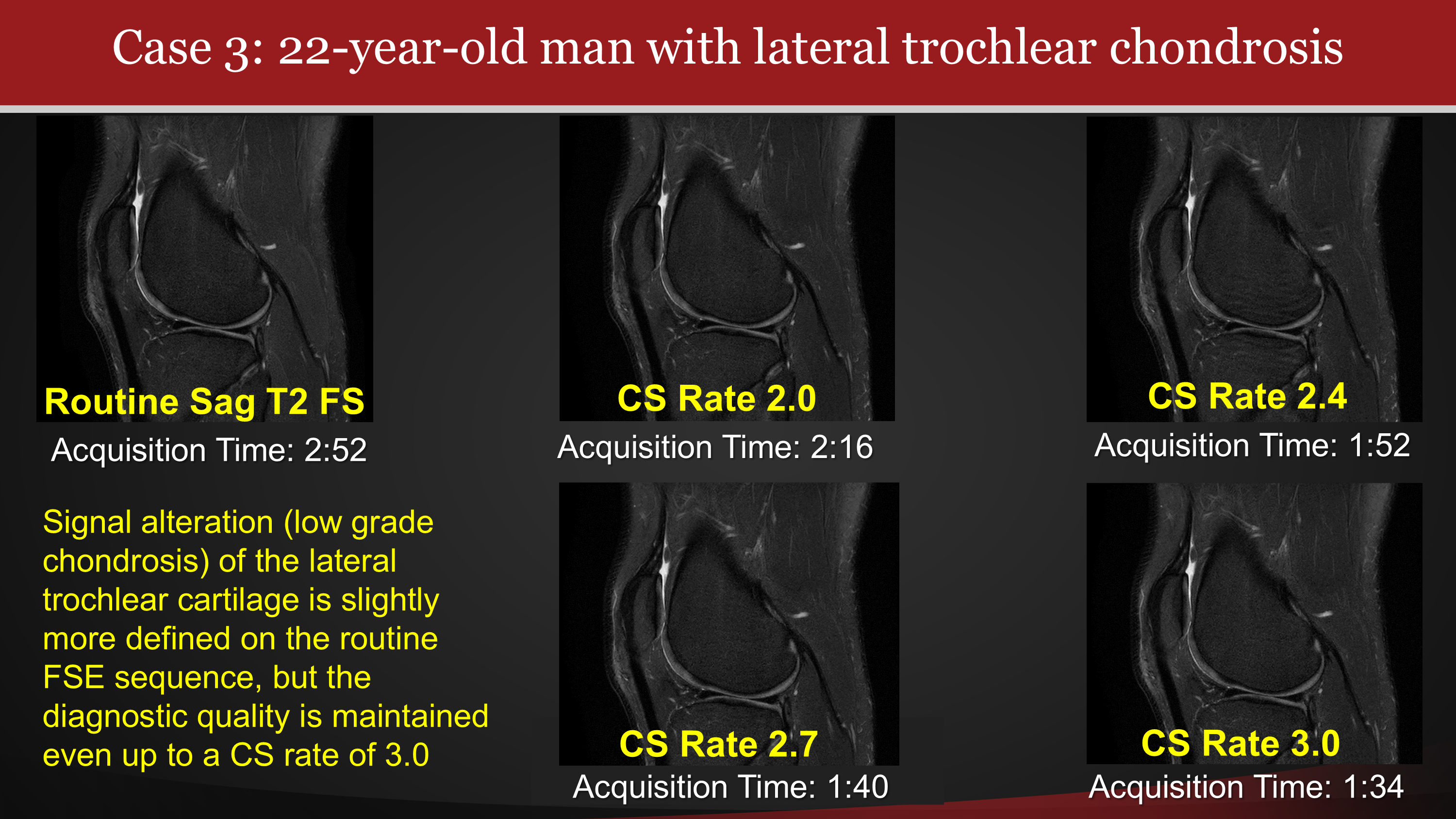 MRI Compressed Sensing Reconstruction